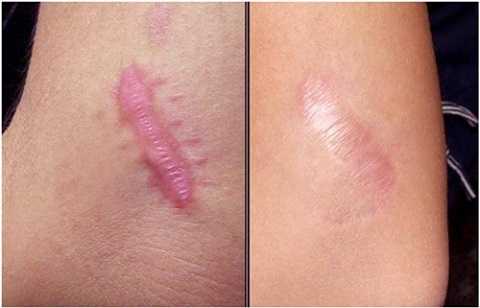 Điều trị sẹo